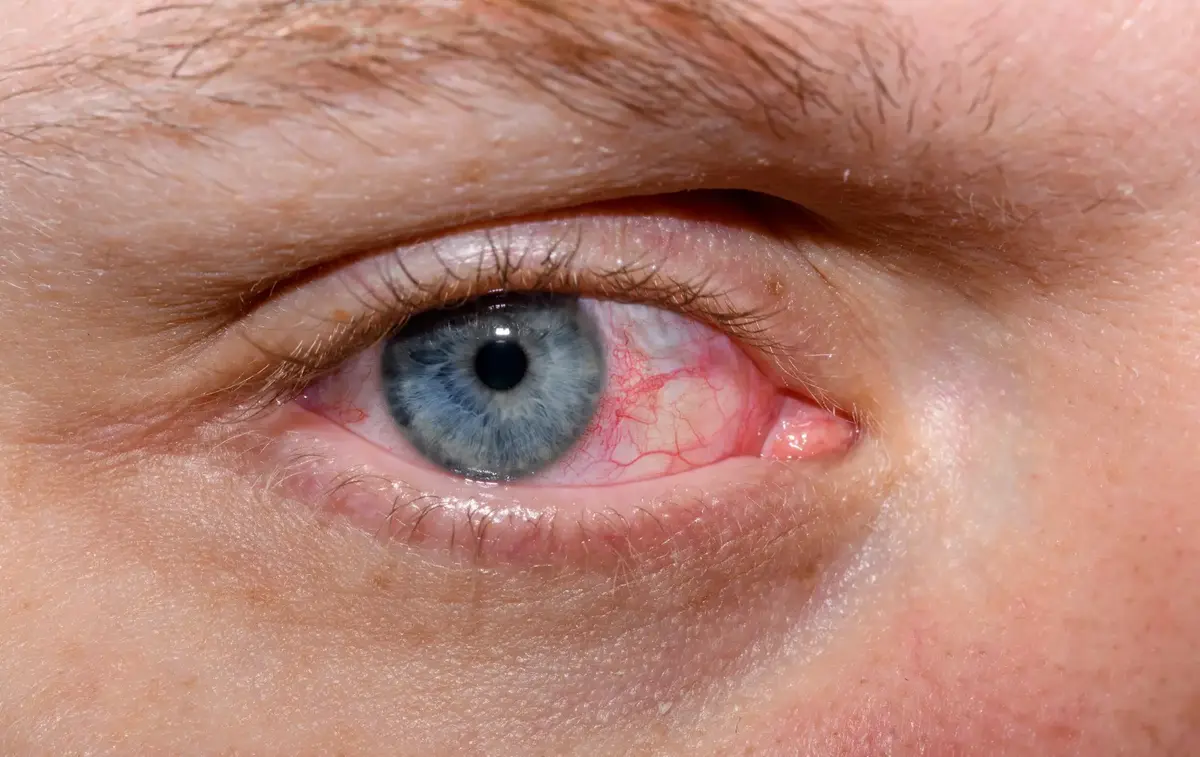 Dry eye syndrome and visual health